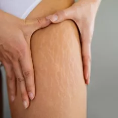 Nos conseils pour un traitement naturel des vergetures Nos conseils pour un traitement naturel des vergetures