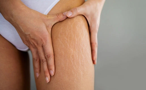 Nos conseils pour un traitement naturel des vergetures