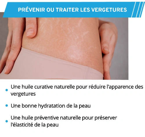 Solutions naturelles pour traiter les vergetures